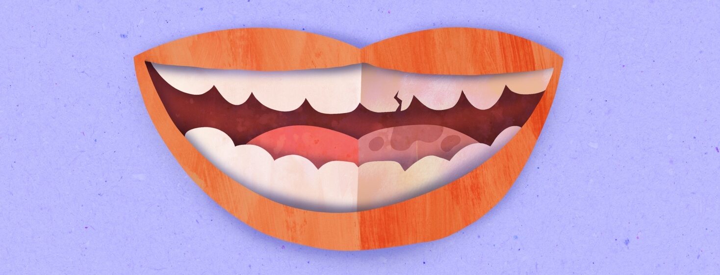 A smiling mouth that shows half the teeth are healthy and half are decayed
